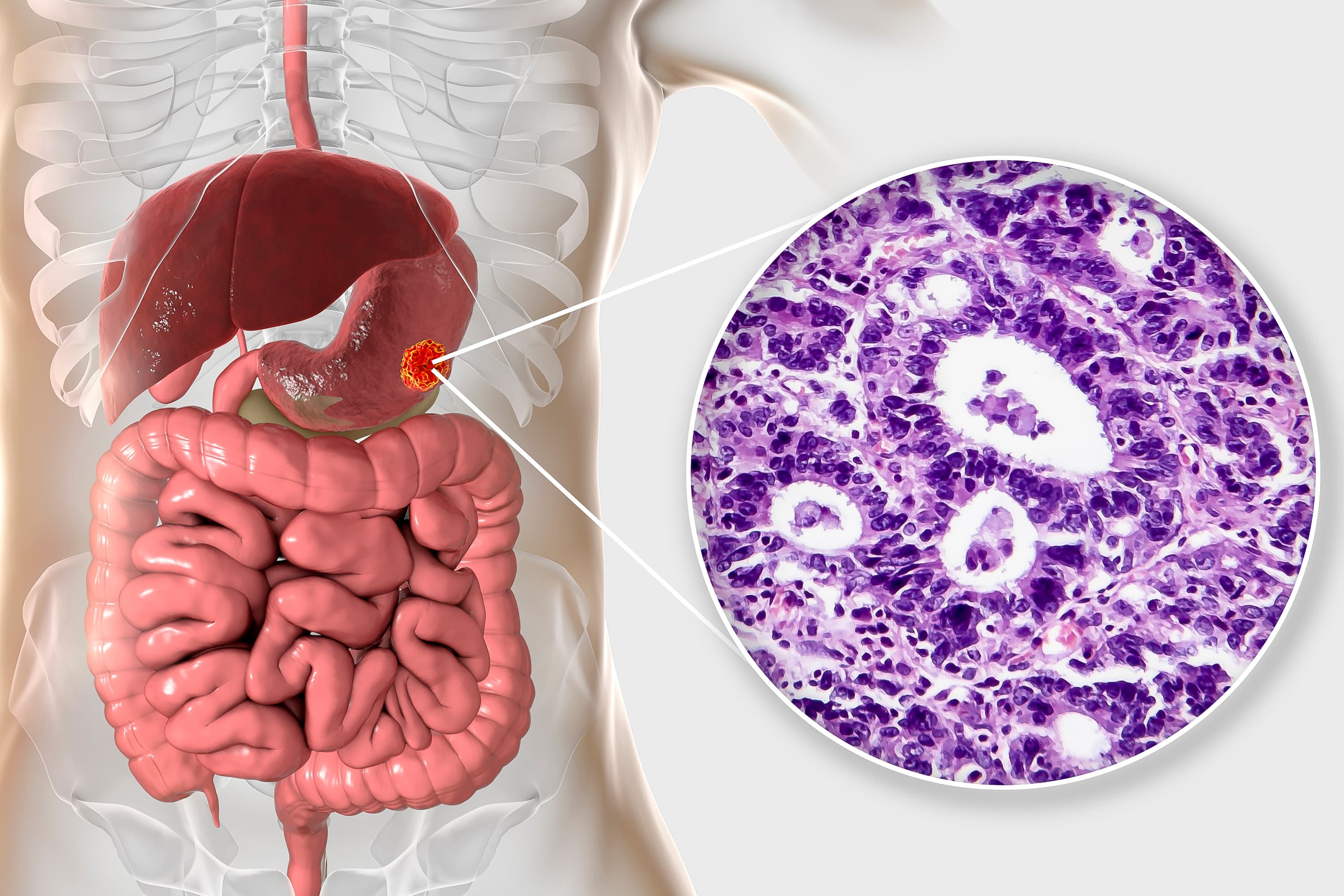 Inmunoterapia es efectiva en Cáncer de Estómago operable